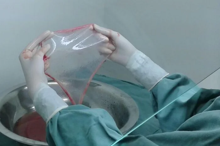 Membrana da placenta vira curativo e SUS aprova uso em pacientes com queimaduras
